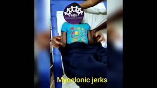 MYOCLONIC JERKS [upl. by Mohsen]