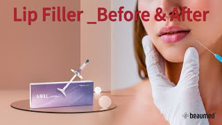 MiFill Deep Lip FillerBefore amp After [upl. by Aicilehp]