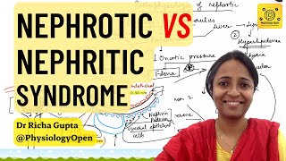 Nephrotic vs nephritic syndrome pathology  MBBS  Glomerular diseases patho [upl. by Retsae991]