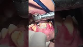 anterior teeth deep caries cleaningteeth dentist mountains tourvlogger calmdown dentist [upl. by Googins99]