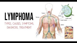 lymphoma Hematology by ASM Minds team [upl. by Zarla]