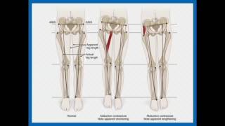 Clinical and Radiological Assessment of Skeletal Malalignment  Dr Farokh Wadia [upl. by Shane]