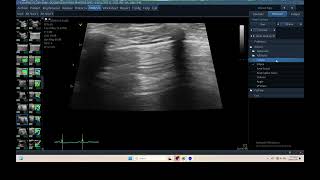 IQ 320 TFAST LUNG ULTRASOUND ECHOPAC ANALYSIS 3 [upl. by Nohsyt123]