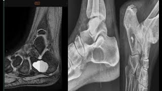 5 cases radiology calcaneal bone lesions musculoskeletalmskquizradiopediamrictxrayanatomyt [upl. by Esinrahs]