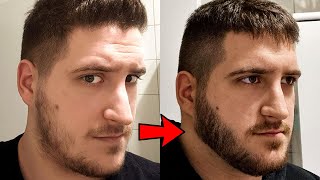 6 month minoxidil transformation thanks Derek for the advice [upl. by Schulz408]