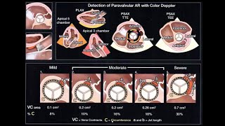 Echocardiographic Assessment of Prosthetic Valves [upl. by Euk859]