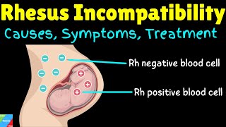 Rhesus Incompatibility  Rh Incompatibility in Pregnancy – Causes Symptoms Diagnosis amp Treatments [upl. by Aneej861]