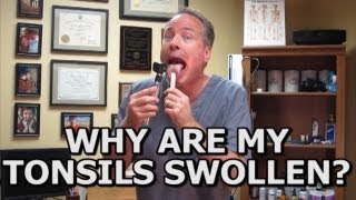 Natural Solutions For Swollen Tonsils How To Avoid A Tonsillectomy Common Sense Medicine [upl. by Aynotak]