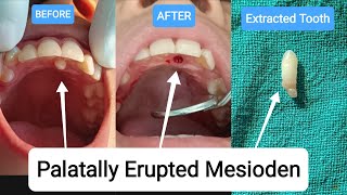 🇳🇵Extraction of Supernumerary Tooth Mesiodens Extra Tooth Exodontia Palatally Erupted nepal [upl. by Smada875]