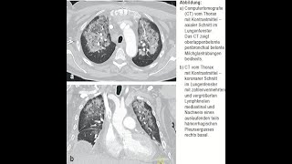 Daptomycin assoziierte eosinophile Pneumonitis [upl. by Madaih]