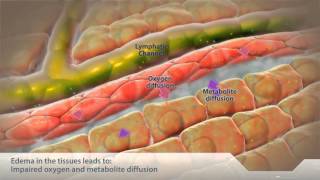 Consequences of Fluid Overload  Tissues [upl. by Erdreid298]