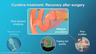 Pancreatic Cancer Treatment and Outcomes [upl. by Neely]