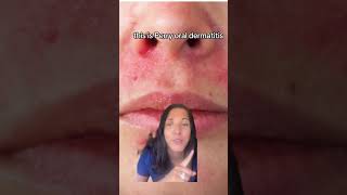 Dermatologist explains Perioral Dermatitis perioraldermatitis [upl. by Adnalra666]