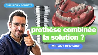 Dents mobiles  les implants dentaire pour stabiliser un appareil [upl. by Hola]