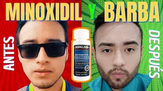 ✅ MINOXIDIL y BARBA  🛑 7 Errores que cometes al aplicar Minoxidil 🛑  Opinión Médica 👨‍⚕ [upl. by Niar]