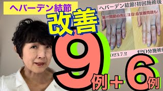 ヘバーデン結節改善9例！リウマチなどその他6例も♪ [upl. by Itnahs]