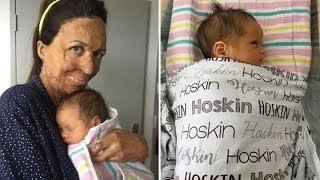 Turia Pitt welcomes her first baby with fiance Michael Hoskins [upl. by Elton675]