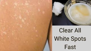 Apply This On Skin to Clear WHITE SPOTS  WHITE PATCHES VITILIGO  CREAM REACTION [upl. by Akerdal]