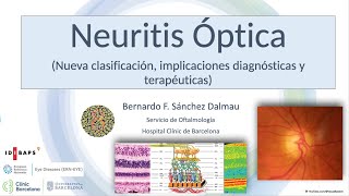 Neuritis Óptica Nueva clasificación implicaciones diagnósticas y terapéuticas [upl. by Eneloj]