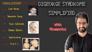 Digeorge Syndrome  Etiopathogenesis Clinical FeaturesDiagnosis and Management [upl. by Suirtimed576]