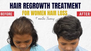 PRP Hair Loss Treatment For Females Before amp After Results at CARA [upl. by Isaacs]