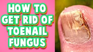 Toenail Fungus Treatment at Home A Fast Cure You Must Try [upl. by Sucramd]