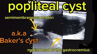 Popliteal Cysts Bakers Cysts Common Findings on Ultrasoundquot [upl. by Anerehs]