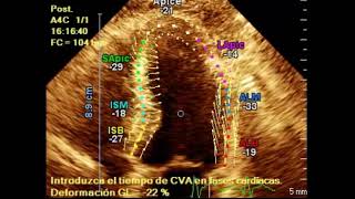 Strain Miocárdico del Ventrículo Izquierdo [upl. by Gillian]