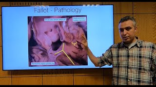 Fallot Tetralogy Part 1 En  Hatem Hosny [upl. by Nawad23]