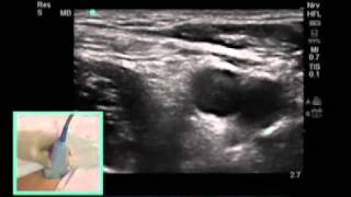 How To FEMORAL NERVE BLOCK  Dr Auyong Scanning Technique Video [upl. by Adnohral]