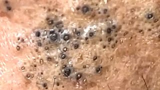 Blackheads Satisfying Removal 0003 [upl. by Rednas]