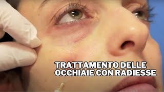 Trattamento delle Occhiaie con Radiesse Dr F Bernardini [upl. by Chin]