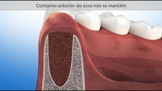 Dente extraído sem preservaçã do rebordo [upl. by Airetahs]