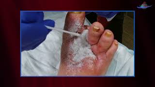 WCW Applying Altrazeal to a Post Surgical Diabetic Foot Ulcer [upl. by Frederiksen]