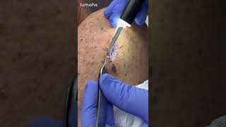 Challenging Suture Removals in Broken Down Dehisced Skin Wounds with Lumohs [upl. by Norven]