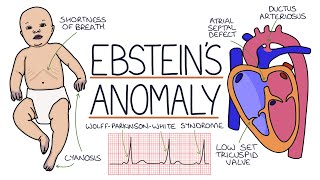 Understanding Ebsteins Anomaly [upl. by Peter277]