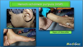 HenochSchonlein PurpuraHSP  Clinical features  Pathophysiology  Diagnosis and Treatment [upl. by Isabelle]