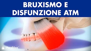 Bruxismo e disfunzione articolazione temporomandibolare © [upl. by Rehtse]