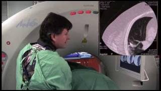 Radiofrequency ablation of colorectal metastasis to lung [upl. by Maggio521]