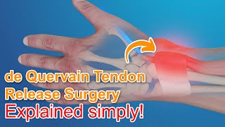 De Quervain Tendon Release Surgery  Explained [upl. by Erelia784]