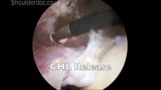 Cuff Releases  anterior and CHL  viewing from posterior and working from lateral  labelsmov [upl. by Jaine220]