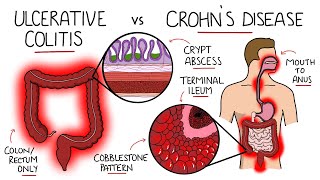 Inflammatory Bowel Disease  Ulcerative Colitis v Crohns Disease With Histology amp Manifestations [upl. by Huai716]