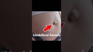 Umbilical hernia I Laparoscopic treatment of Umbilical hernia [upl. by Eslud]