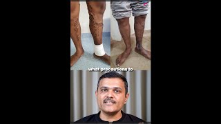 Varicose Veins EXPERT Shares Top Care Secrets After Treatment GUJARATI [upl. by Anits]