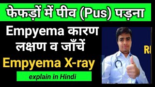 What is Empyema। Empyema X ray । फेफड़ों में पीव पड़ना । Pus Collection in Lungs Pleural Effusion [upl. by Lahsiv]