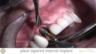 Colocación de Implante Biohorizons  Place Tapered Internal Implant [upl. by Rosenkranz]