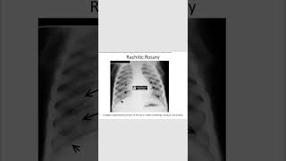 Rachitic rosaryricketsradiology neetpg [upl. by Sitruk]