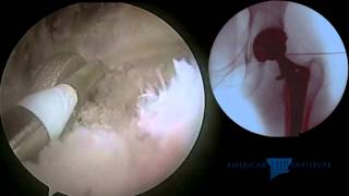 Hip Arthroscopy Total Hip Replacement  Iliopsoas Tendon Release for Impingement on a Collared Stem [upl. by Ytineres932]