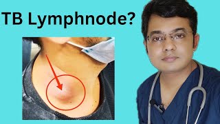 TB Lymphnode Symptoms Diagnosis amp Treatment Tuberculous lymphadeniyis [upl. by Wrennie125]