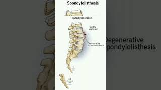 Spondylolisthesis shorts [upl. by Adgam]